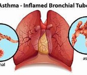 What is asthma