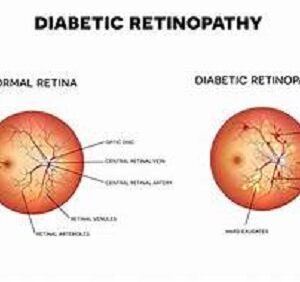 Diabetes Retinopathy