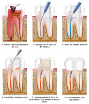 Root Canal treatment