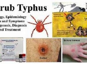 Facts About Scrub typhus in UP