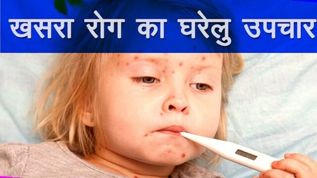 खसरा (Measles) क्या हैं