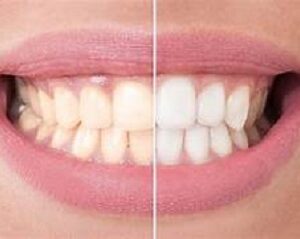 Teeth whitening or bleaching