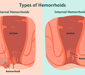 What is Piles or Hemorrhoids