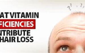 Excess hair loss - A sign of Vitamin B12deficiency