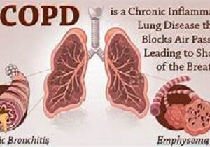 Follow Ayurveda for the rescue of Coronary Obstructive Pulmonary Disease (COPD)