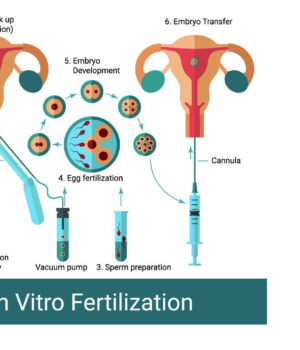 infertility treatment